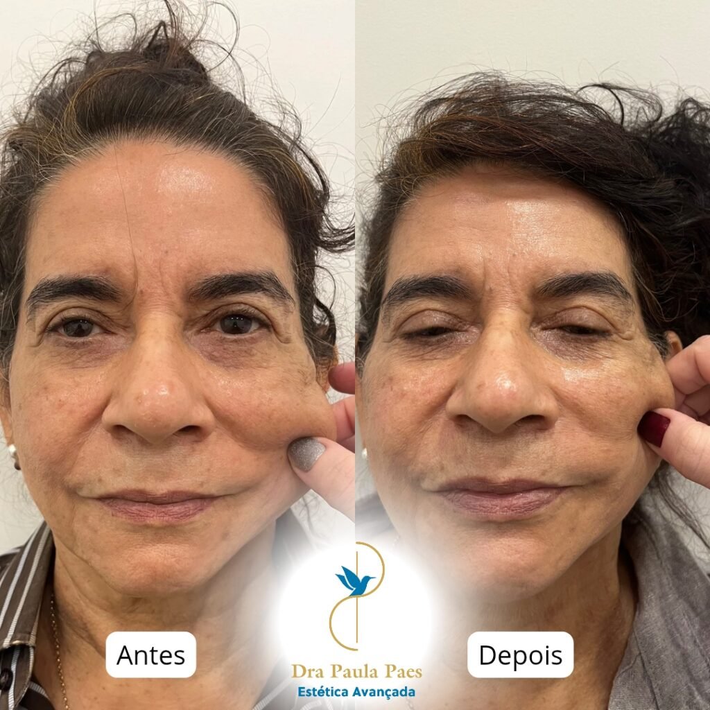 Antes e depois do Bioestimulador de Colágeno