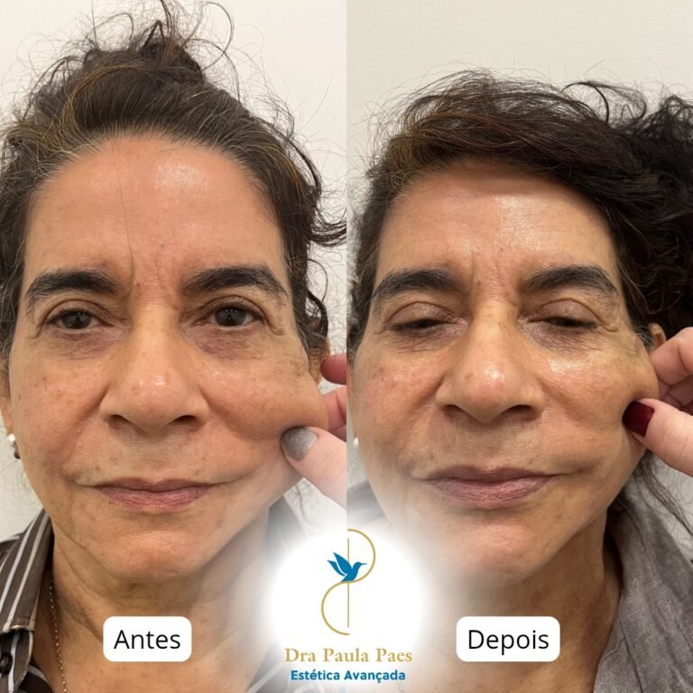 Antes e depois do Bioestimulador de Colágeno